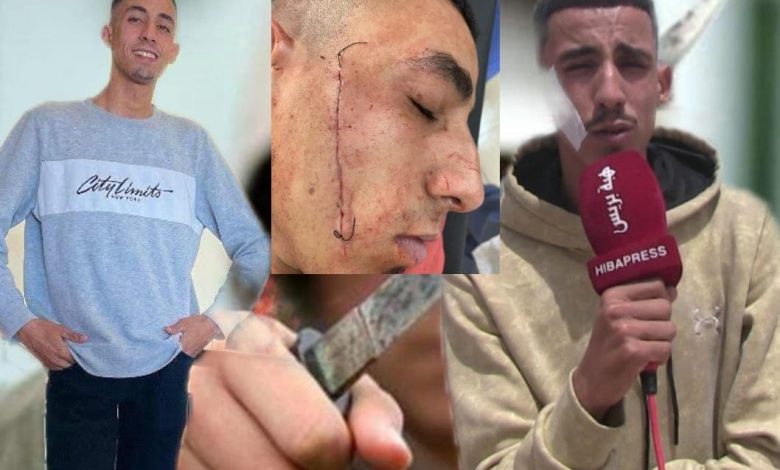 الشاب “نزار ” ضحية “التشرميل “.. من حياة هادئة إلى معاناة مستمرة (فيديو)